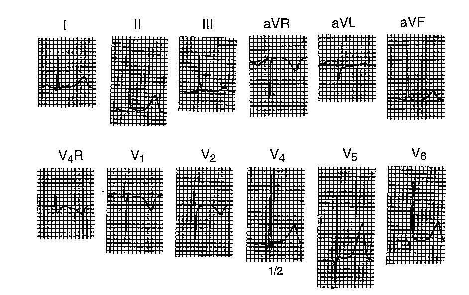 3-8 yaş Adultlarda görülen R/S progresyonu kuraldır (sağ perkordiallerde