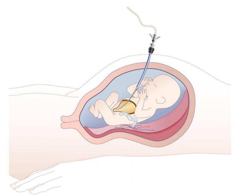 Fetal sistoskopi Quintero tarafından 1995 te