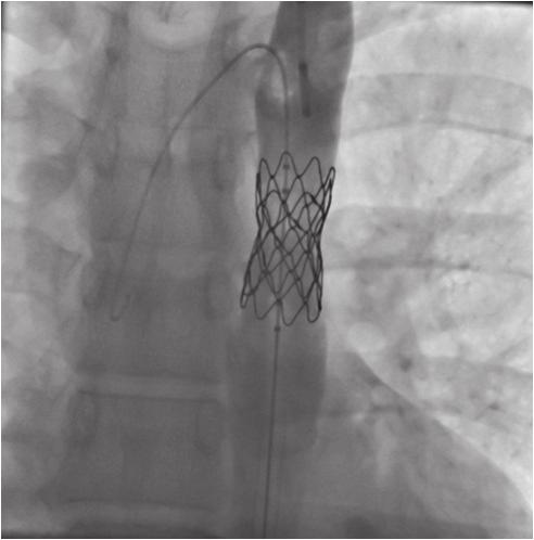 saptandı, bilgisayarlı tomografi (BT) ile ileri incelemede ligamentum arteriozum seviyesinde AK izlendi ve eşlik eden ek patoloji saptanmadı.
