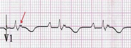 Sağ ventriküler outflow tract taşikardi (RVOT): Egzersiz veya katekolamin deşarjı ile indüklenen siklik AMP