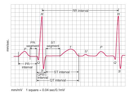 NORMAL EKG PATERNİ: Hız 60-100/dk PR<200 ms,>120 ms (3-5 küçük kare) QRS süresi<100 ms (2.