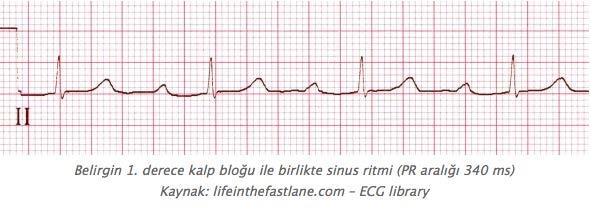 PR İNTERVALİ,BLOKLAR: P dalgasının