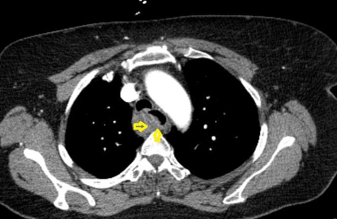 Introduction Esophageal intramural submucosal hematoma is a rare and uncommon condition which presents symptoms of the acute coronary syndrome, dysphagia, odynophagia or abdominal aortic aneurysm (1).