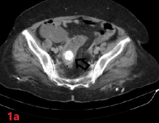 Her abdominal computed tomography (CT) demonstrated a hyperdense area with lamellar structure that was 3.5x2.5 cm in diameter at the sigmoid colon.