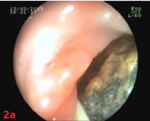 (Figure-1a). The findings were consistent with gallstone ileus at the sigmoid colon and suggested that the fistula was at the hepatic flexure.