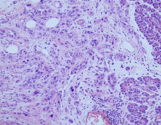 Case Report A 78-year-old male patient complaining of jaundice had been examined and there was a total icterus of entire body. The gallbladder was palpated in the examination of the abdomen.