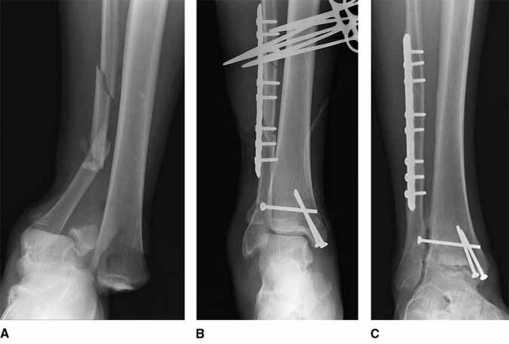 Mara L. Schenker, MD, ve ark. 3 6 8 9 A, B, C, ları takiben ilerleyici dejenerasyon ve klinik sonuçlara atfedilebilir.