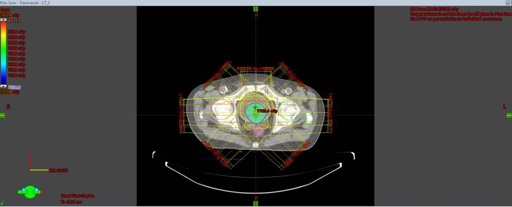 Şekil 3.4: 7 alanla ve 6 MV foton enerjisiyle yapılan 3D-CRT tedavi planı doz dağılımı 3.2.