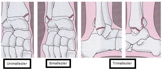 Uygulamada sıklıkla kullanılan, radyolojik bulgular temel alınarak hazırlanmış basit ve tanımlayıcı Henderson sınıflandırmasıdır. (Şekil 1.18) (21, 23, 24, 89-91). Şekil 1.