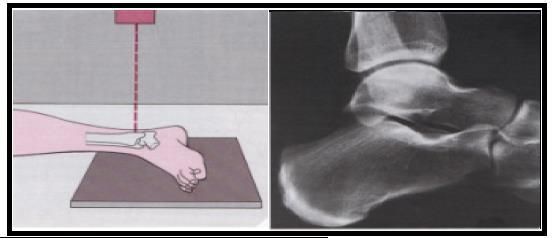 olmalı ve talusun öne veya arkaya deplasmanı net değerlendirilmelidir. Lateral grafide fibula tibianin posterior korteksi ile üst üste binmiş pozisyondadır.(şekil 1.28) (21, 72, 91).