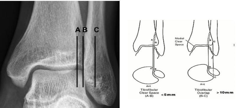 ölçümü ile tibiofibuler aralık elde edilir. 5 mm den az ölçülmesi normal kabul edilir. (Şekil 1.34) (21, 28, 72, 107, 108). Şekil 1.