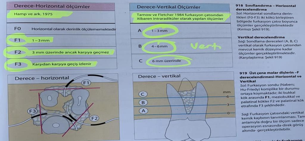 yapılır. Altsınıf A: Furkasyon çatısından itibaren 0-3 mm lik derinlik.