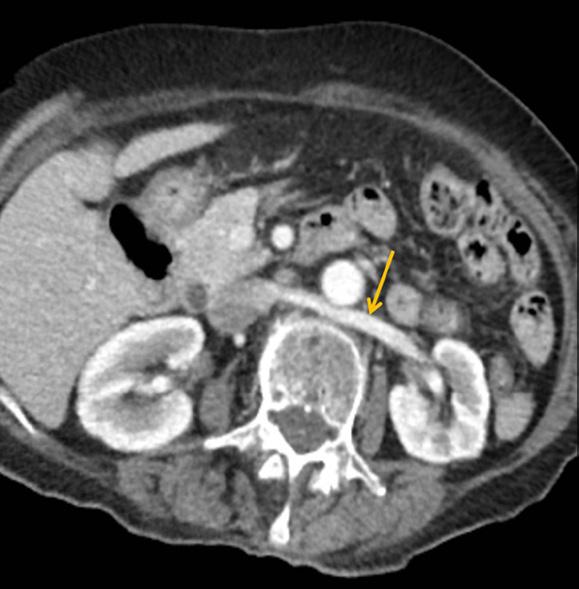 Elli altı yaşındaki erkek hastaya ait aksiyel ve koronal reformat abdomen BT görüntülerde retroaortik sol