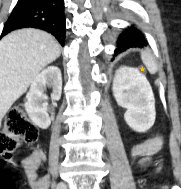 renal ven (ok) ve sol böbrek üst polde küçük boyutlu bir basit kist (yıldız) görülüyor. Tablo 2.