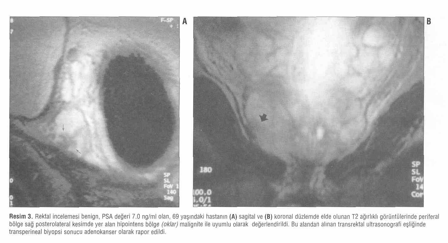 celemesinin prostat kanseri saptaması açısından sensitivite, spesifisite, pozitif ve negatif doğru kestirim oranları ve toplam kesinlik oranları sırası ile; %83, %93, %71, %96 ve %91 olarak
