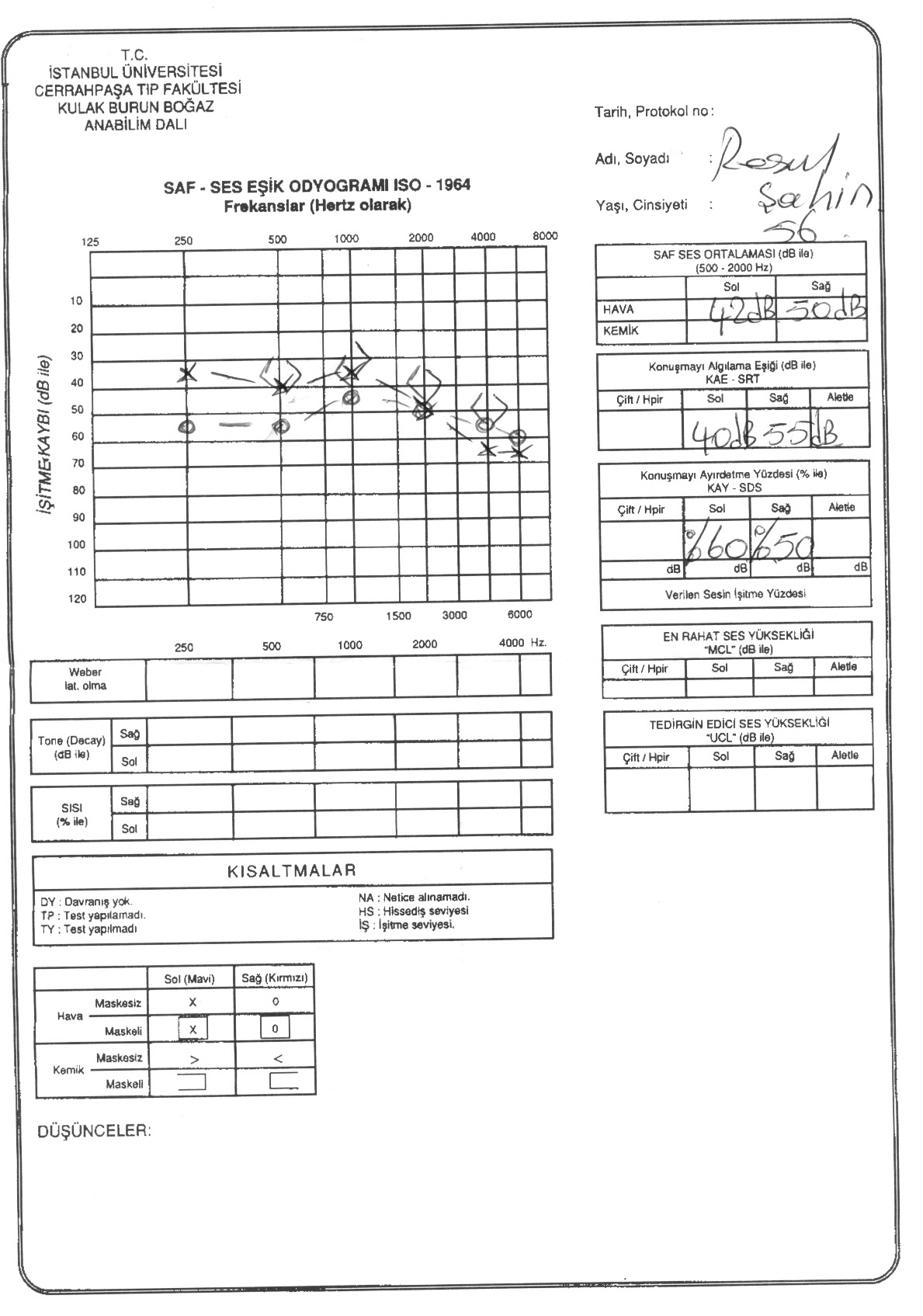 Şekil 2. Hastaya bir yıl sonra yapılan odyometri testinde; sağda 50 db, solda 42 db, olmak üzere bilateral nörosensoriyel işitme kaybında kısmi bir iyileşme tespit edilmiştir.