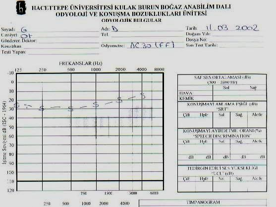 Şekil- 11: Serbest alan işitme testinde