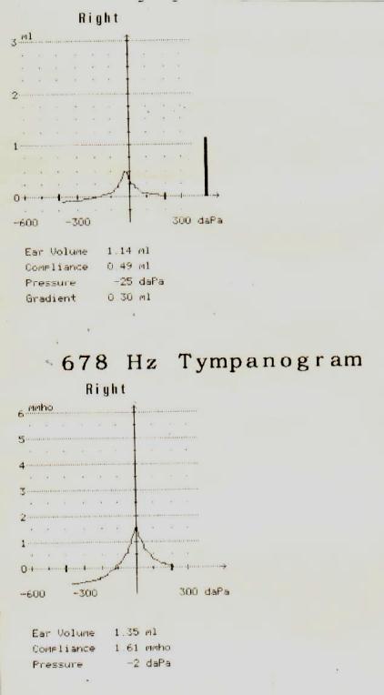 A B Şekil- 16A 16B: Farklı timpanogram tipleri, [B şeklinde verilen timpanogramın alt kısmında yer alan ölçüm, 678 Hz Probe ton kullanılarak çizilmiştir(yüksek Frekans