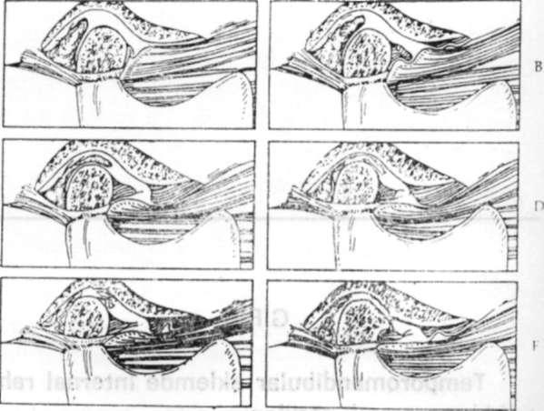 Medial ve lateral diskal ligamentler eklemi alt ve üst eklem kavitesi olarak ikiye ayırır, bunlar kollajen bağ dokusu yapısındadır uzayamazlar diskin kondilden ayrı hareketine engel olurlar, bu