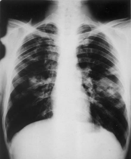 Resim 4. Otuzüç yaşında erkek hastaya KML nedeniyle SCT yapıldı. Kronik GVHH ve bronşiyolitis obliterans (BO) tanısı olan hastada BO tanısından beş ay sonra tüberküloz gelişti.