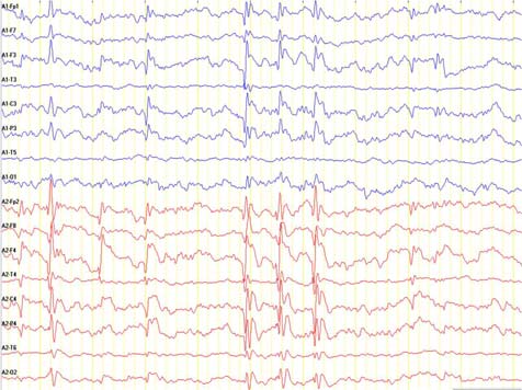 92 Rolandik epilepsi her zaman selim bir hastalık mıdır? yapmakta ve genelliklede 15 16 yaşlarda klinik bulgular gerilemektedir (3).