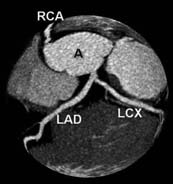 Rutin kardiyak incelemeler sonras nda birçok fazdan görüntü rekonstrüksiyonu yap larak (%30, %40, %50, %60, %75, %80) de erlendirme aflamas nda koroner arterler için en uygun faz seçiyoruz.