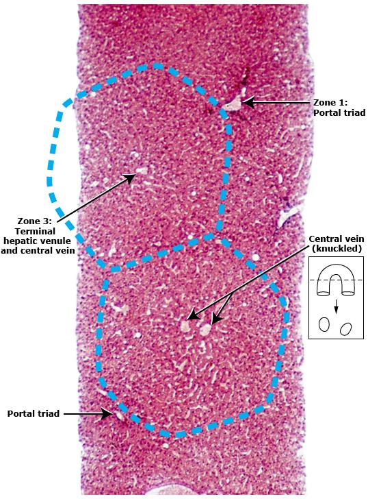 Karaciğer fibrozu =kronik