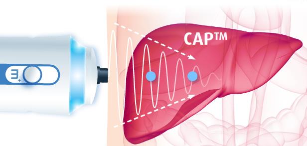 Parametre Birim Temel Klinik Uygulama Karaciğer Sertliği kpa Fibroz ölçümü Kontrollü Atenüasyon Parametresi (CAP) db/m Steatoz