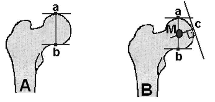 Alt Ekstremite Deformite Analizi (I) Alt Ekstremite Deformite Analizi (I) Mehmet Çakmak*, Korhan Özkan** Alt ekstremite deformite analizi 5 alt grupta incelenir. Bunlar: A.