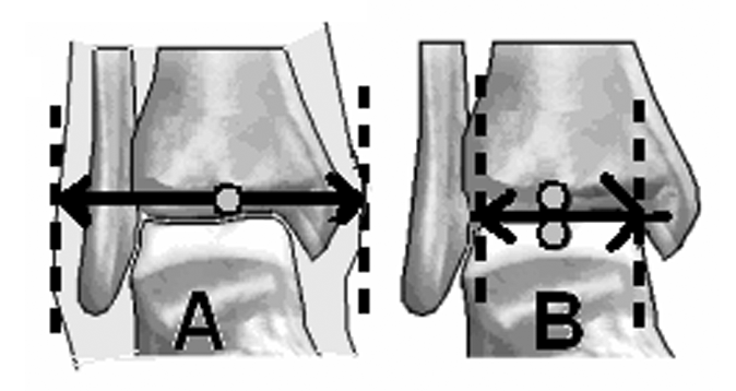 Ýki eksen arasýnda açý 0 derecedir. Bu nedenle pratikte anatomik ve mekanik eksen ayný kabul edilir (Þekil 10c). Frontal planda femurun anatomik ve mekanik eksenleri farklýdýr.