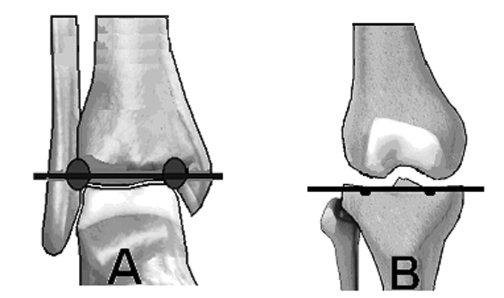 Tibia Eklem Oryantasyon Çizgileri Frontal planda tibia distal eklem oryantasyon çizgisini çizmek için, distal tibianýn subkondral çizgisi esas alýnýr (Þekil 12a).