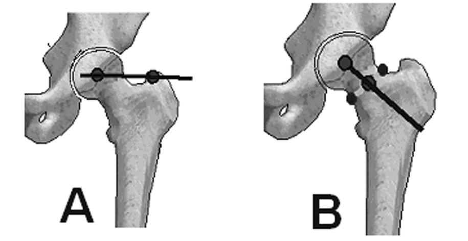 Frontal planda femur proksimal eklem oryantasyonu için iki çizgiden yararlanýlýr. 1. Büyük trokanter tepe noktasýný femur baþý merkezi ile birleþtiren çizgi (Þekil 14a). 2.