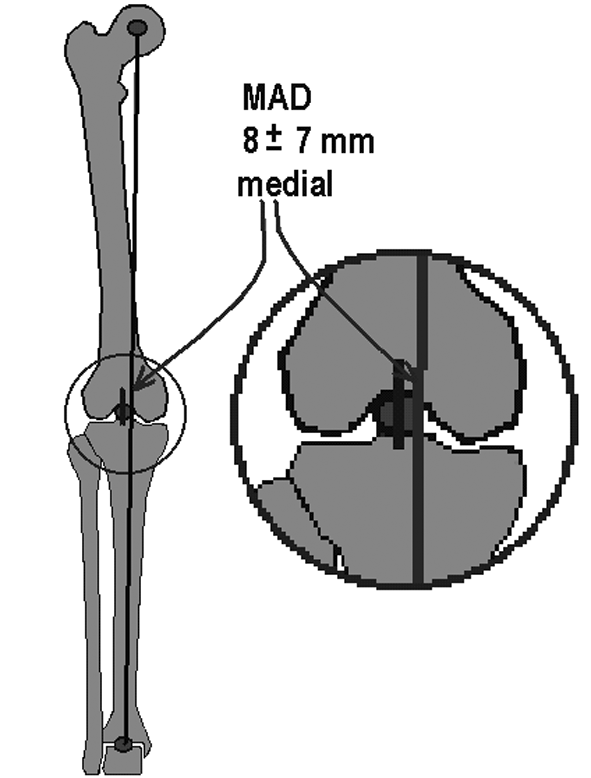 Bu açý normalde 87,5±2,5 derecedir (Þekil 23). Bu açý 90 dereceden büyükse femurda deformite vardýr ve varus deformitesini gösterir.