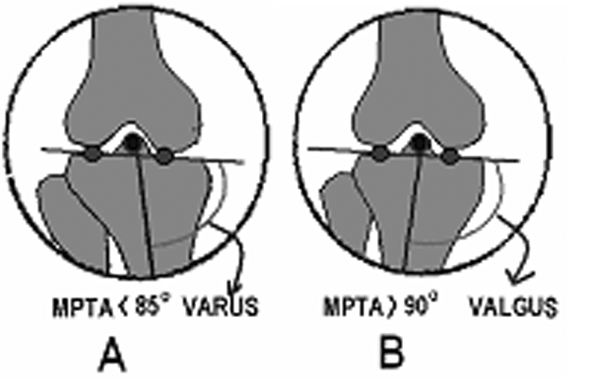 Ayný þey femoral kondiller için de geçerlidir, fakat femoral kondiller yuvarlak olduðu için tibial platoda olduðu kadar anlamlý deðildir (Þekil 30).