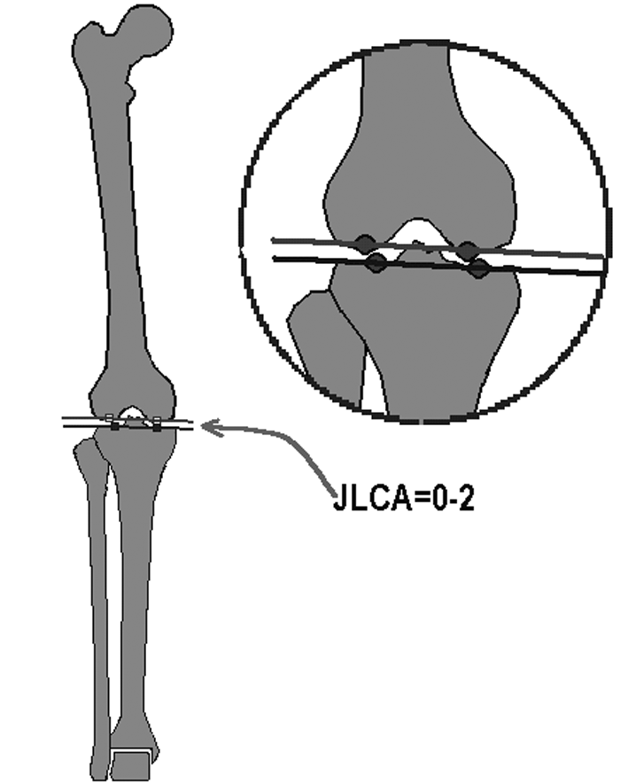 Mehmet Çakmak, Korhan Özkan ile birleþtirilir (Þekil 31). b. Femur mekanik ekseni çizilir. c.lateralde oluþan mlpfa ölçülür. (Þekil 32). d. Normalde 90 derecedir. (Þekil 32a).