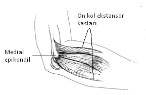 Kas-iskelet sistemi hastalıkları Lateral Epikondilit El bilek ekstansör kas tendonlarının lateral epikondile yapıştıkları yerde oluşan inflamasyon Ön kol arka kısmında ağrı vardır.