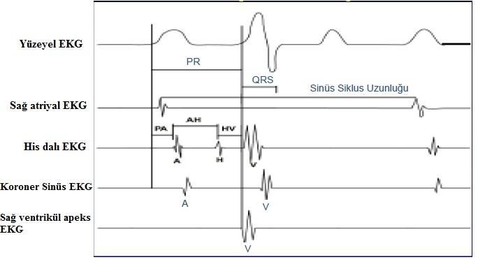 Temel Elektrofizyoloji Protokolü Kateterlerin yerleştirilmesi sonrasında kılavuzlar tarafından belirlenen protokoller doğrultusunda standart işlemler gerçekleştirilir (16).