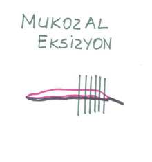 Baş Boyun Patolojisi Makrokopik İnceleme: Biyopsi Makroskopik inceleme: Materyal boyutları belirlenerek insizyonel biyopsiler mukozaya dik şekilde 2 mm kalınlıkta kesilerek örneklenir.