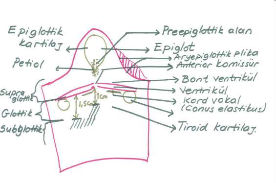Total larenjektomi NOT: Glottik bölge ventrikülden 0,5-1cm ye uzanan alan olarak tanımlanmaktadır. Subglottis ventrikülün 1 cm altından başlar. 1,5 cm kullanılmamalıdır.