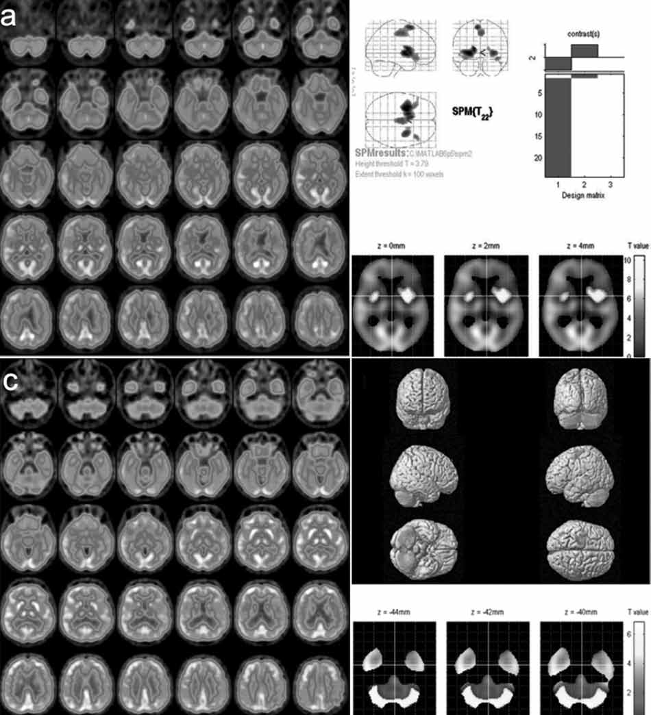 Parkinsonizmin Görüntülenmesinde Son Gelişmeler: Nükleer Tıp Yaklaşımı 17 yola çıkılarak her hastalık için ayırt edici tutulum (hipometabolizma) biçimleri tanımlanmıştır (Tablo 2).