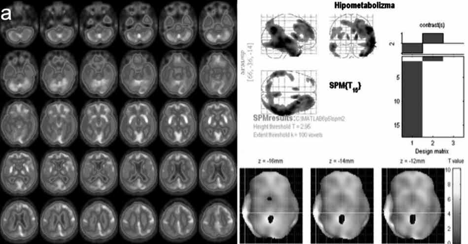 (a) Aksiyel kesitlerin görsel olarak değerlendirmesinde yaygın sağ hemikortikal, sol temporal hipometabolizma ve iki taraflı putminal hipermetabolizma bulguları izlenmektedir.