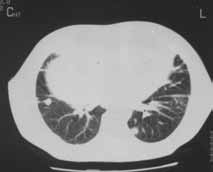 1 B Lenfosit % 4 aktif T lenfosit % 34 CD4 % 33 T Lenfosit % 74 CD8 % 37 makrofaj % 3 0 CD4/CD8 0, 89 Oral 1mg/kg/gün metil prednizolon a eflde er dozda oral deflazokort tedavisi ( 60 mg / gün )