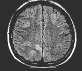 Beyin MRG: Frontoparietal ve bilateral nükleus kaudatus bölgesinde sitotoksik