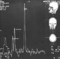 Resim 1. Normal spektrum. N-asetil aspartat (N), kolin (Cho) ve kreatine (Cr) ait rezonans pikleri izleniyor. Resim 2. Kistik glial tümör.