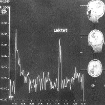 ncak in vitro ve in vivo çal şmalarda, nekrotik tümörlerde aminoasitlerin varl ğ gösterilememiştir.