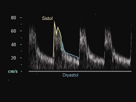 DOPPLER İN UYGUN KULLANIMI 25 DOPPLER ÖLÇÜMLERİ Doppler spektrumu, parametrelere dikkat edilerek uygun şekilde elde edildiğinde tanıya yardımcı niceliksel bilgi sağlar.