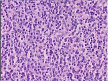 Kitlesel lezyon biyopsisinde MPO ile olumlu boyanan diffüz tümöral infiltrasyon Resim 1.