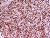 Kitlesel lezyon biyopsisinde CD43 ile olumlu boyanan diffüz tümöral infiltrasyon Hastaların klinik özellikleri tümörün lokalizasyonuna göre değişir.