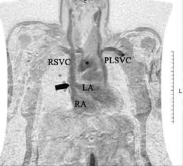 monitoring detected paroysmal atrial brillation The physical eamination as normal ecept for a systolic murmur in the apical and left upper parasternal areas The electrocardiogram shoed normal sinus