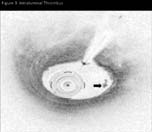 thin-cap broatheroma, plaue rupture, intraluminal thrombus, calcications in some (n) hile the remaining had none of these features (n) Periprocedural events rates ere compared beteen to groups